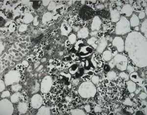 M,7y. | Wilson disease susp. M,7y. | Wilson disease susp.
